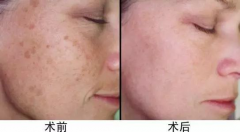 超皮秒價格，超皮秒廠家哪個比較好？